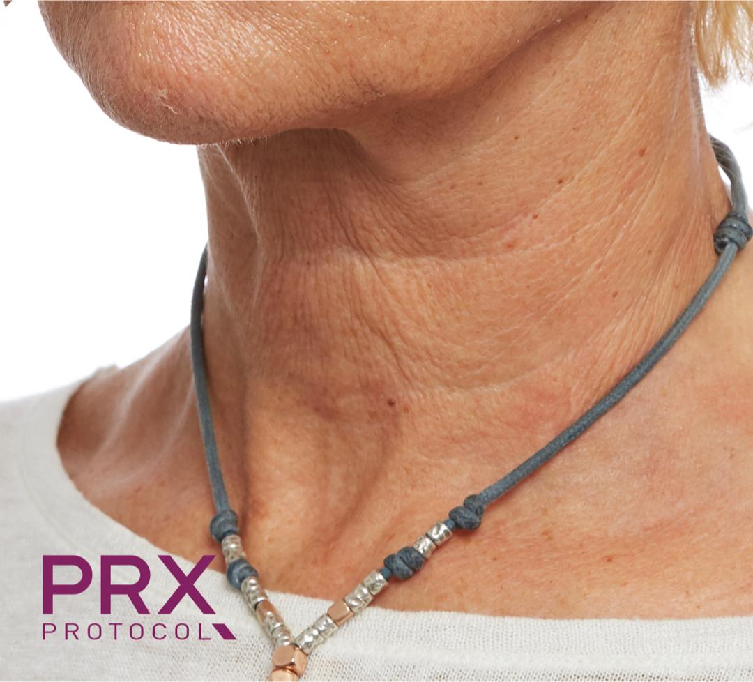 Neck-_A_-AFTER-_1-session-PRX-T33_ Chicago Skincare Studio & Specialty Spa